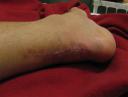 Achilles Heel scar 2 Week 6