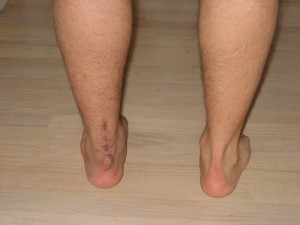 4 months and 3 weeks achilles leg comparison 2