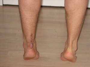 4 months and 3 weeks achilles legs toe raises