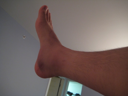 Pre-surgery ATR right food