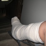 Post-surgery half cast