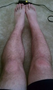 7-days-post-rerupture