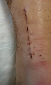 incision on POD12