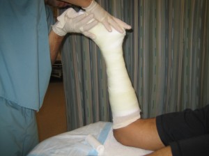 Cast #2 - Fiberglass