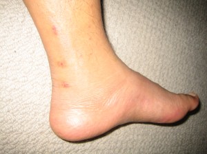 Foot next day 2
