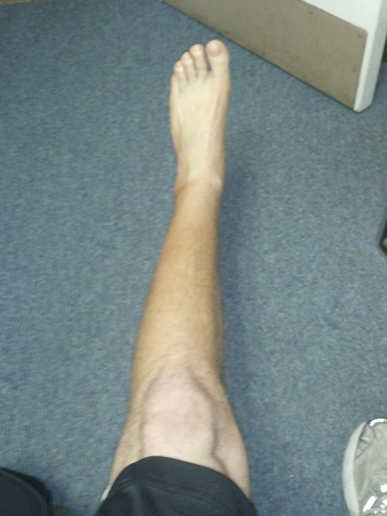 Calf atrophy